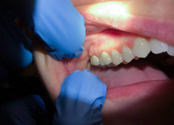 Best Emergency Treatment for Dental Infections or Abscesses in Navarre Beach, FL